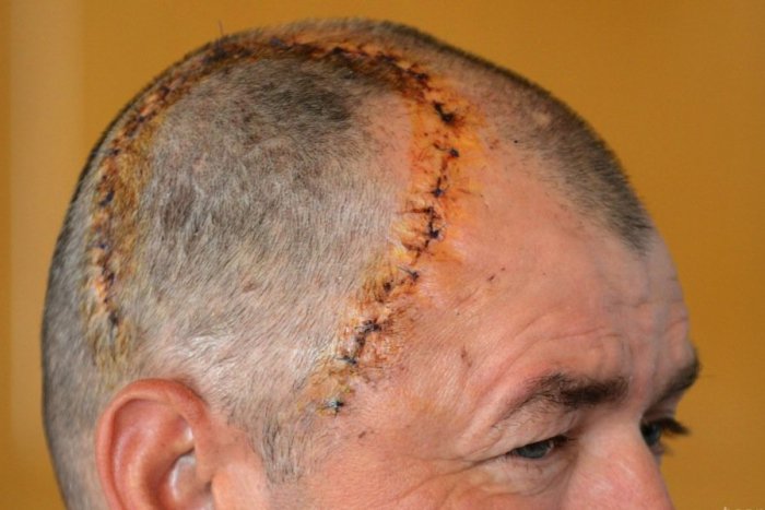 Ilustračný obrázok k článku Milan zo Štrby po hroznom páde: Lekári mu do lebky voperovali unikátny implantát