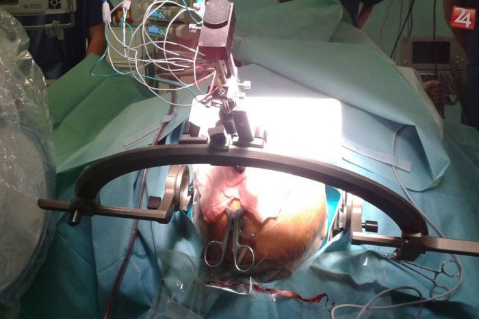 Ilustračný obrázok k článku Košickí lekári použili unikátnu metódu: Elektródy zavedené do mozgu zmenili Istvánovi život