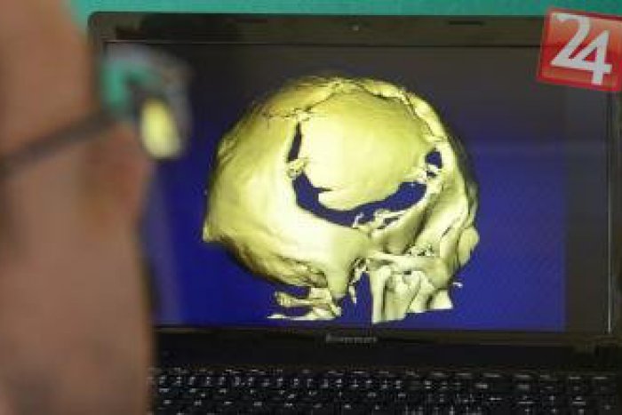 Ilustračný obrázok k článku Košická univerzita medzi akademickou špičkou: Jej unikátne implantáty nahradzujú časti ľudského tela