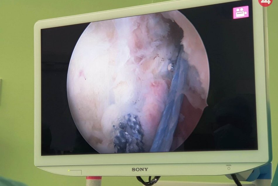 Ilustračný obrázok k článku Žilinská ortopédia s novým typom operácií kolena: Takto to funguje