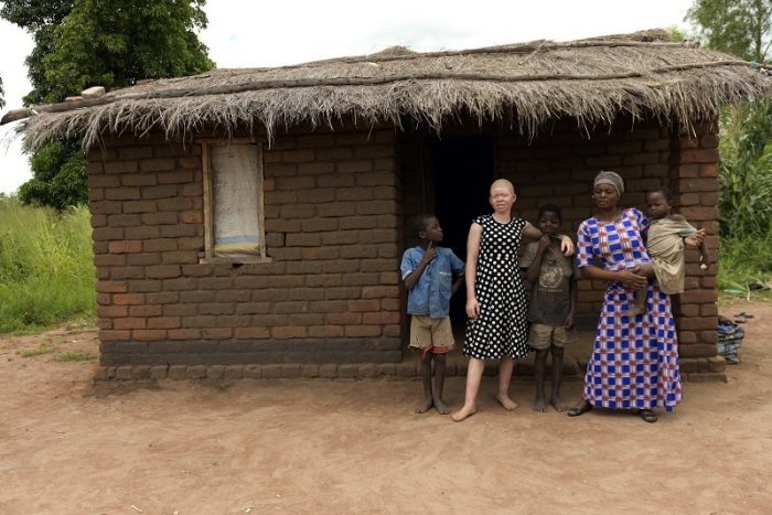 Ilustračný obrázok k článku KURIOZITA DŇA: Africká albínka Catherine je miestnou raritou, bojí sa preto o svoj život
