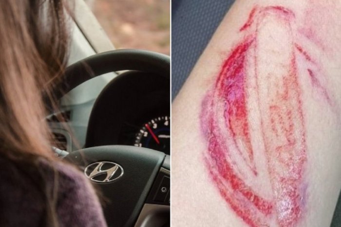 Ilustračný obrázok k článku Airbagy zachraňujú životy, občas zanechajú KRVAVÉ „tetovanie“: Ako k nemu neprísť?