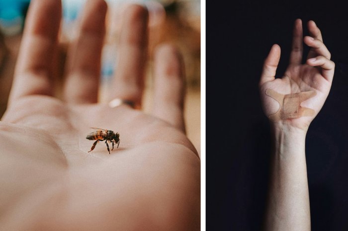 Ilustračný obrázok k článku Uštipol vás hmyz? Vieme, kedy NETREBA vyhľadať doktora a na čo by ste NEMALI zabudnúť