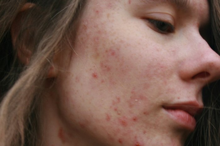 Ilustračný obrázok k článku Sociálnymi sieťami sa šíri nový trend v boji s VYRÁŽKAMI: Dermatologičky pred ním VARUJÚ!