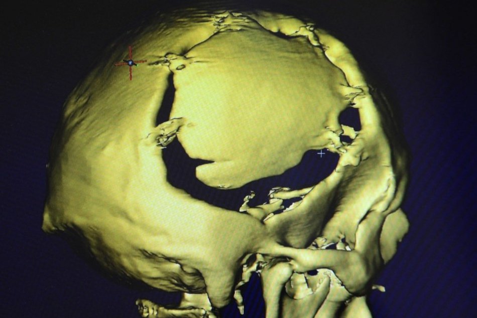 Milan zo Štrby po hroznom páde: Lekári mu do lebky voperovali unikátny implantát