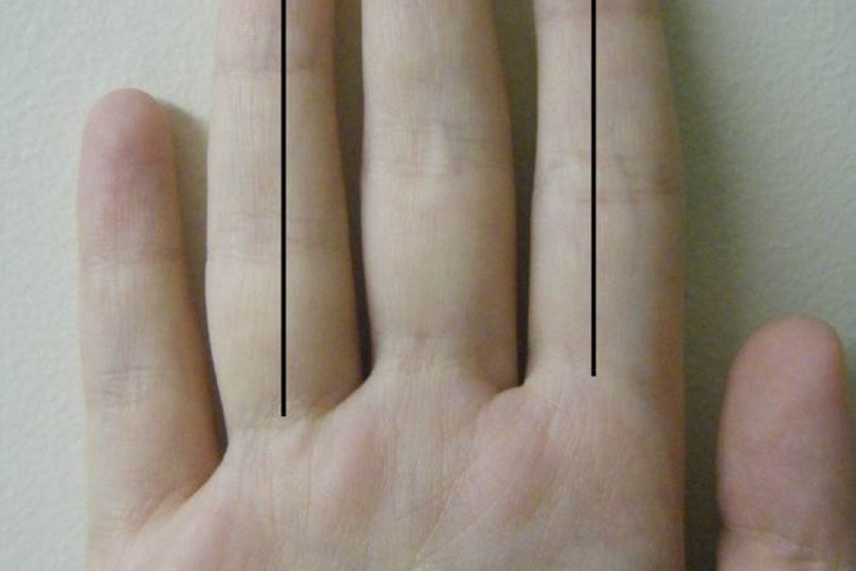 Veľa dokazuje dĺžka druhého prstu