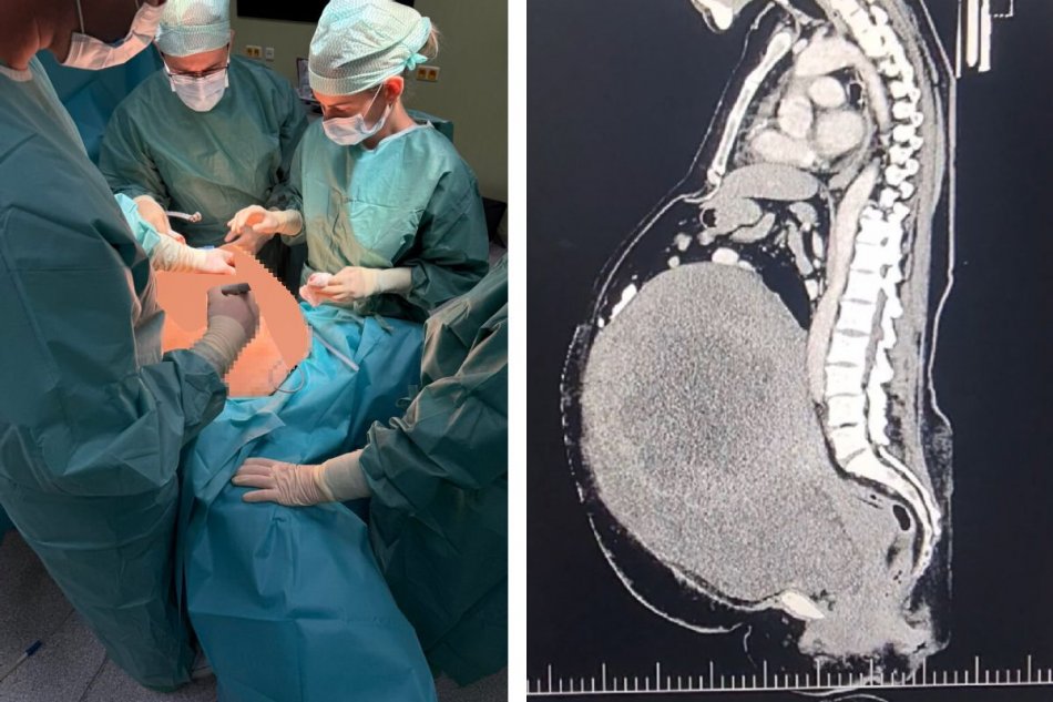 Pacientke vyoperovali z tela 18,6 kilogramový nádor