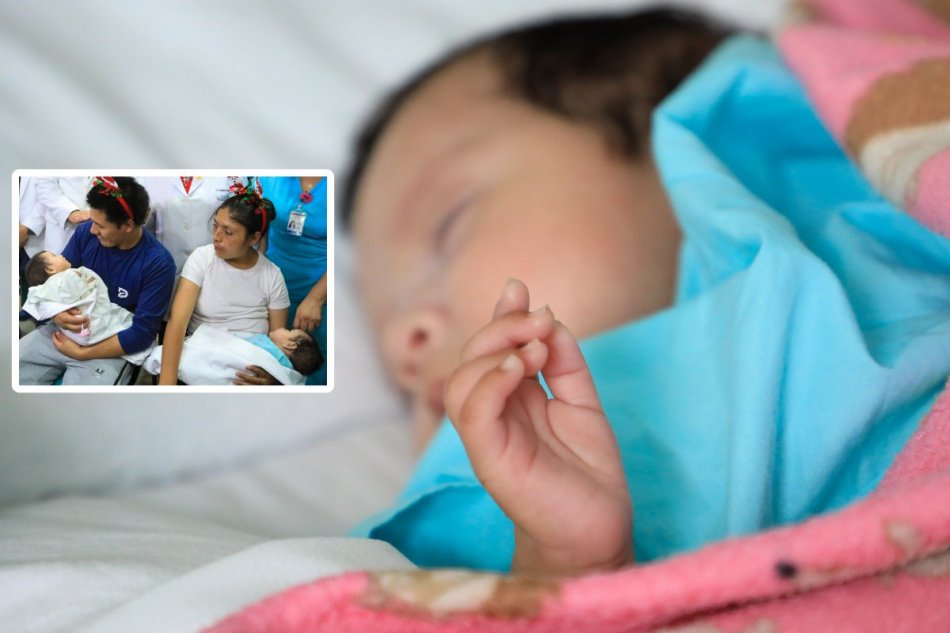 V Peru oddelili dvojmesačné siamské dvojčatá